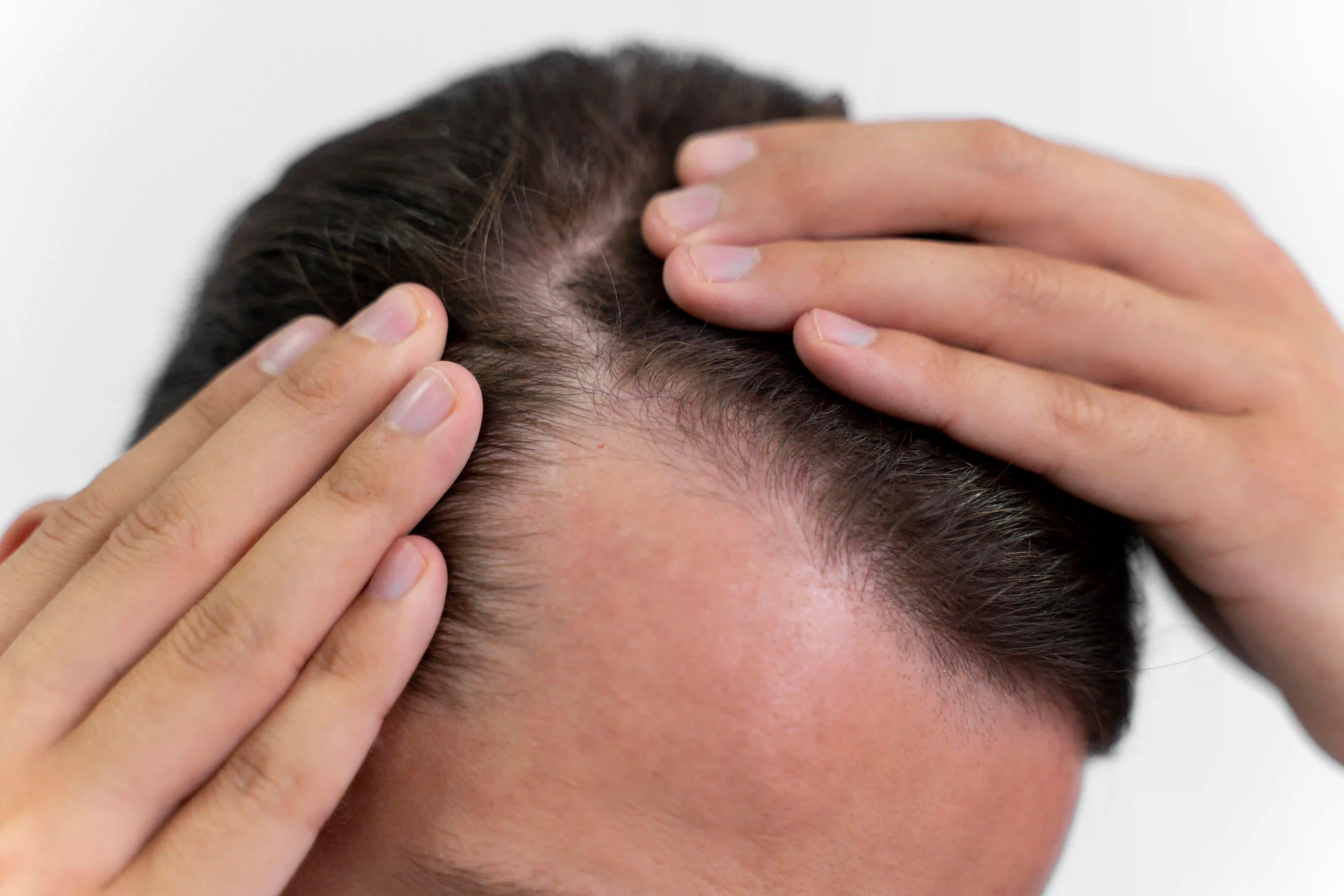 Researchers are trying to leverage AI technology to counter hair loss