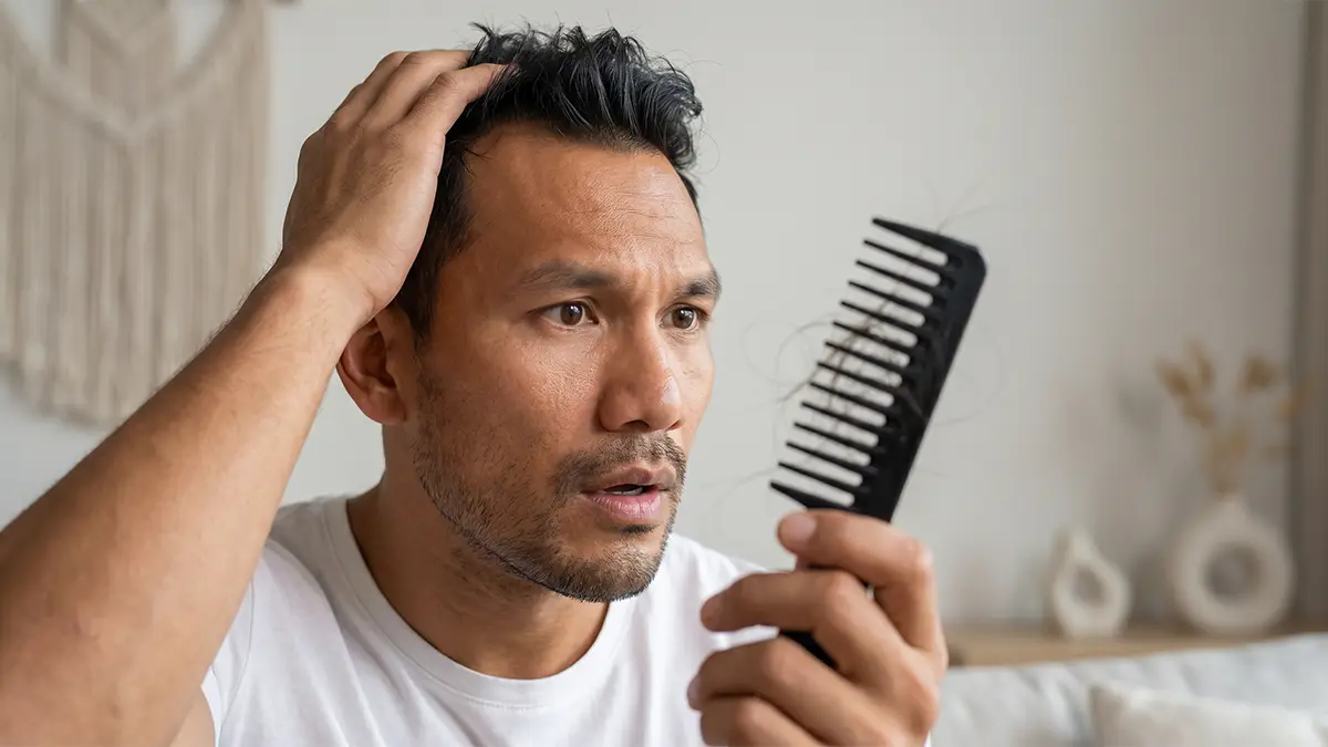 Lalaking tinitingnan ang bald spots niya at nagtataka kung ano ang gamot sa paglalagas ng buhok.
